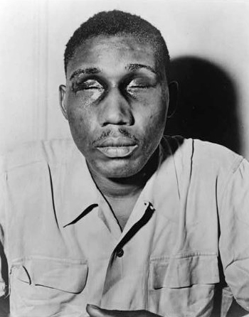 This photo from the NAACP, now in the Library of Congress, shows Sgt. Isaac Woodard Jr., a WWII Army veteran, who was attacked hours after his honorable discharge by South Carolina police while he was still in uniform. The Feb. 12, 1946 beating left him blind but helped galvanize the civil rights movement. (Library of Congress)