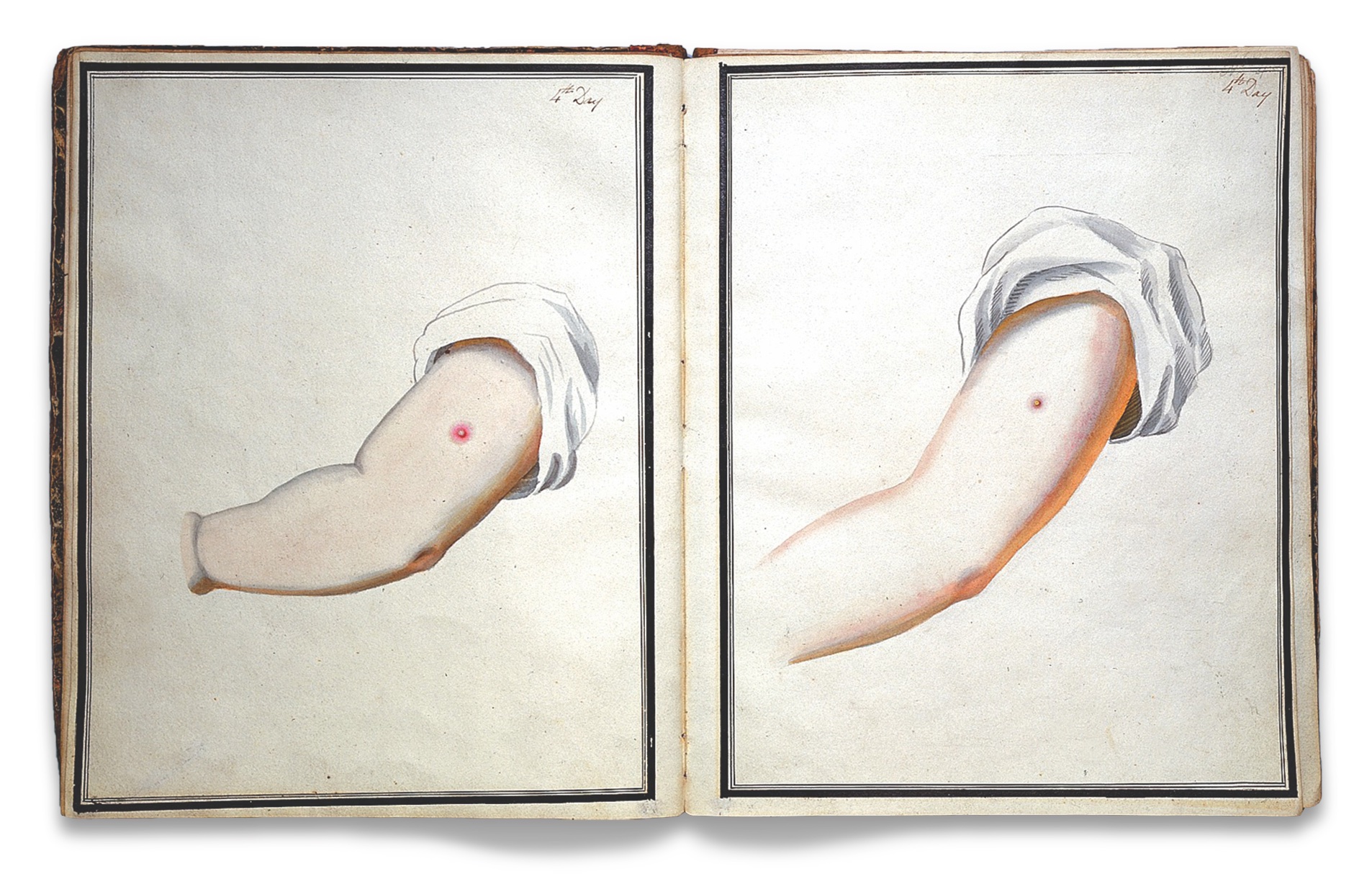 These 19th-century watercolor drawings portray the marked similarity between a smallpox inoculation on the left (variolation) and a cowpox inoculation (vaccination) on the right. (Wellcome Images) 