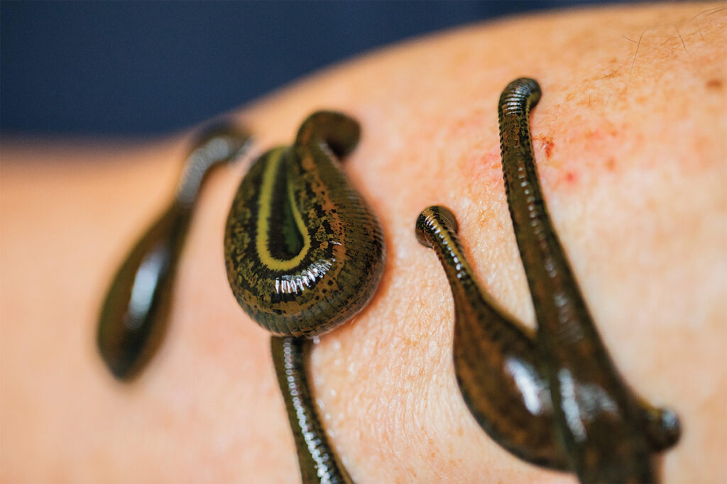 Photo of Leeches sit on the arm of a patient during a leech therapy in the Orthonatura practice group.
